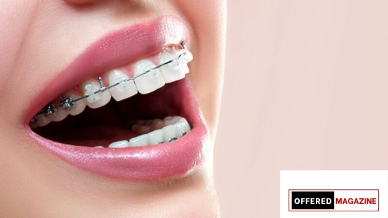 Brasssmile Org: Total Guide to modern dental care and confident smiles.