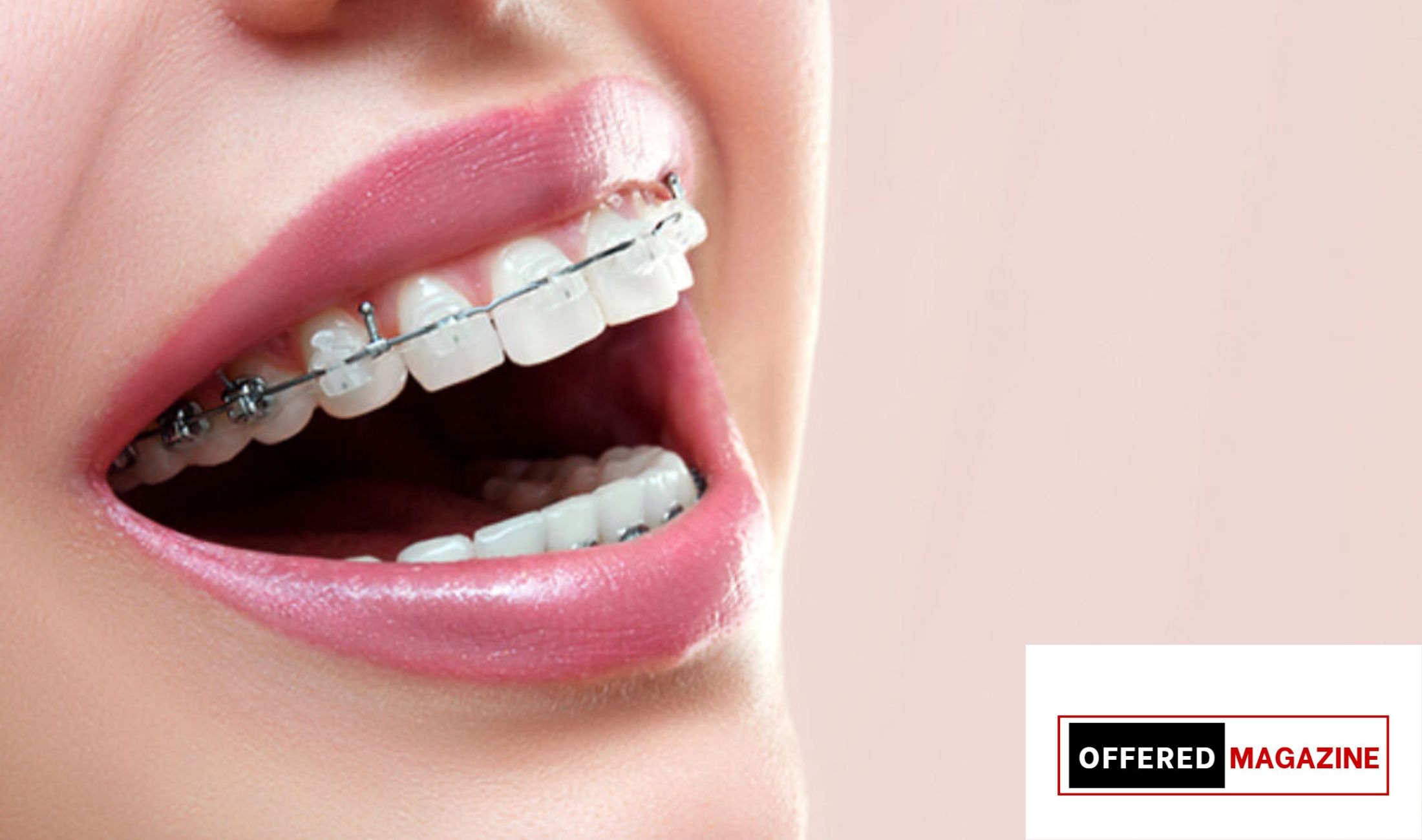 Brasssmile Org: Total Guide to modern dental care and confident smiles.