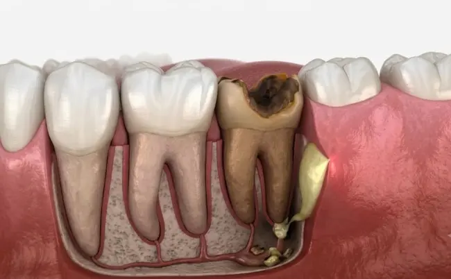 How Long Until a Tooth Infection Kills You? (2026)